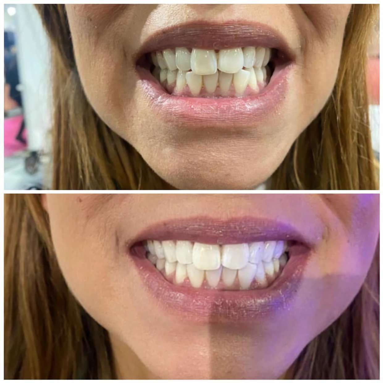 Sourire avant après blanchiment